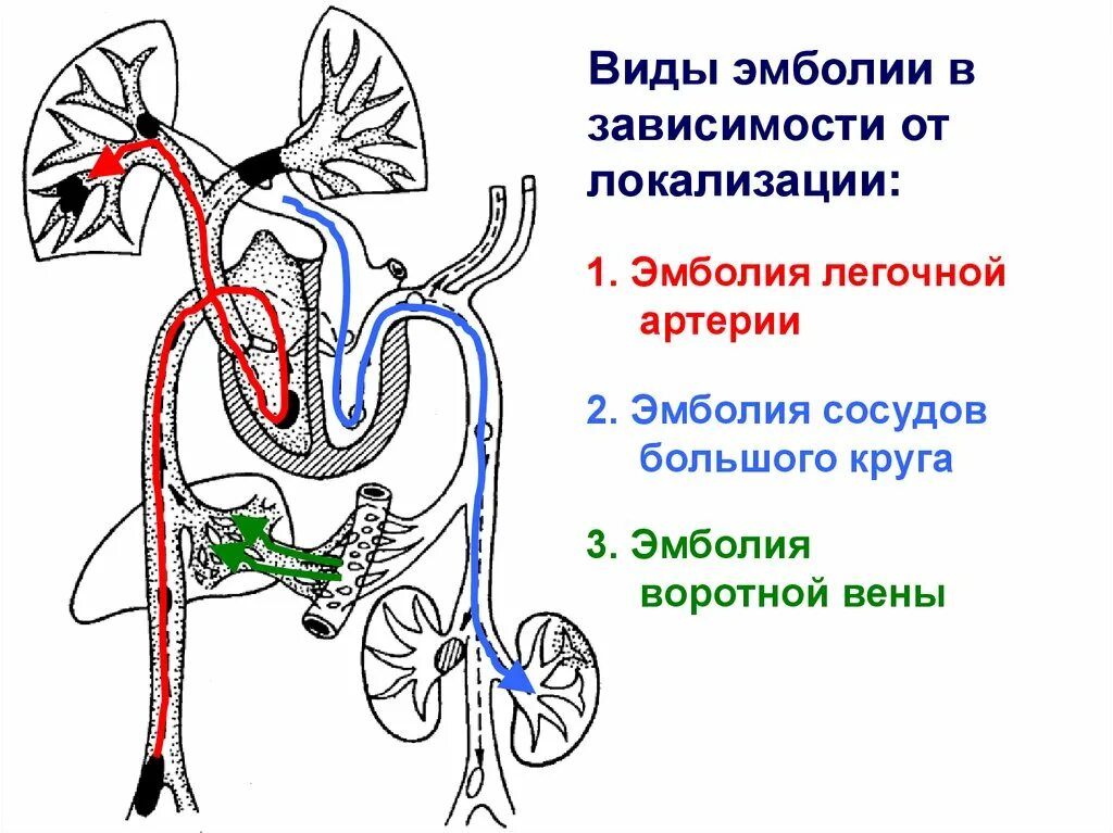 Нарушения малого круга кровообращения. Схема эмболии большого круга кровообращения. Эмболия малого круга кровообращения схема. Путь малого круга кровообращения схема. Схема кругов кровообращения с указанием системы воротной вены.