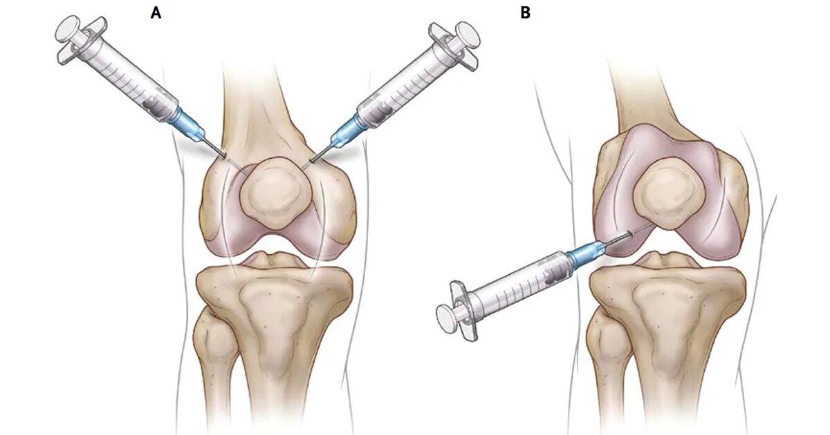 Диагностическая пункция сустава. Пункция коленного сустава. Пункция коленного сустава техника. Техника внутрисуставной инъекции в коленный сустав.