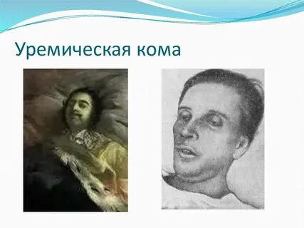 Уремическая кома запах изо рта
