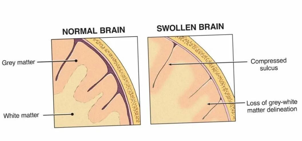 Патогенез отека головного мозга схема. Отек набухание головного мозга. Отёк и набухание головного мозга. Отек оболочек головного мозга. Что значит припухлость