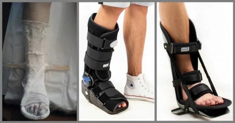 Заменим гипс на пластиковый. Можно ли заменить гипс при переломе. Можно ли заменить гипс при переломе. Турбокаст лучезапястный. Скотчкаст и софткаст.