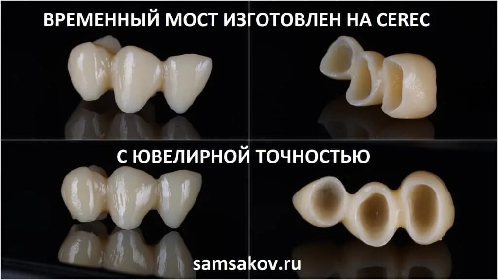 Почему ставят коронки. Временная пластмассовая коронка. Временные пластмассовые коронки на передние зубы. Временные зубы из пластмассы.