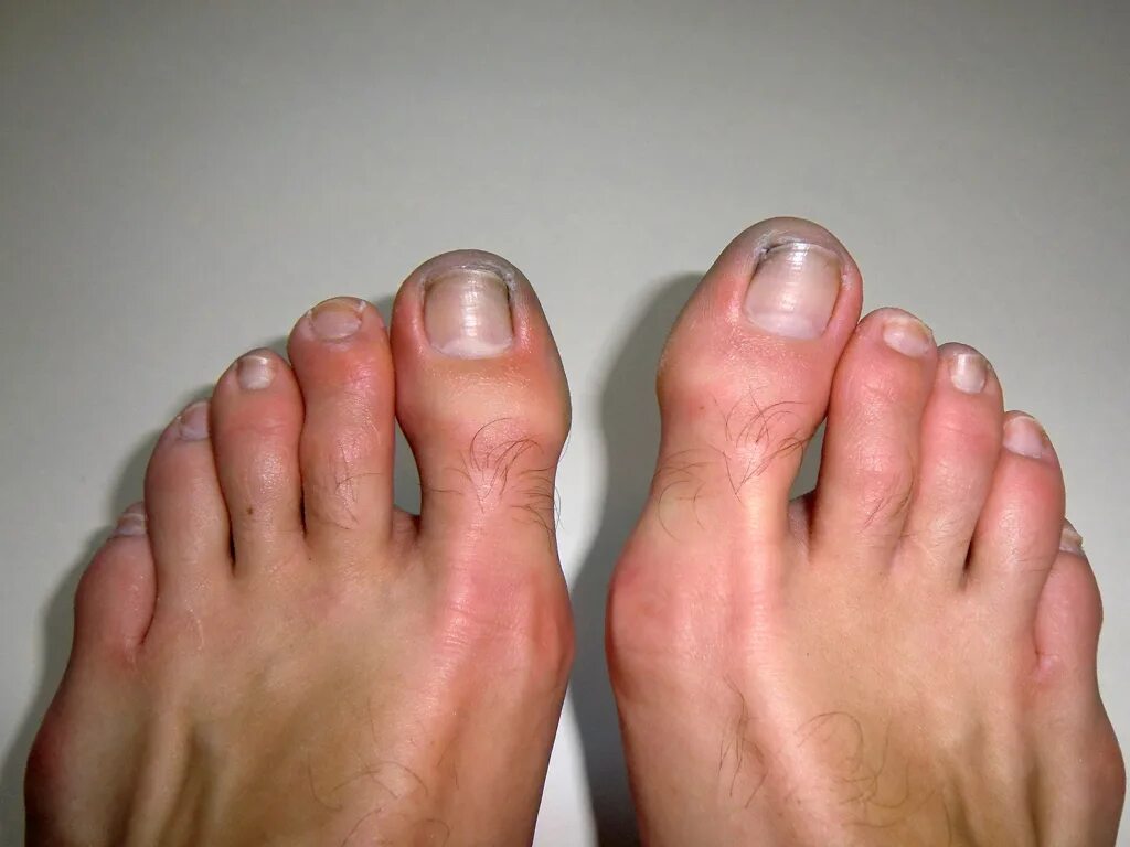 Снег в руках. Отмороженный 4. Обморожение ног гангрена. Отморожение iii степени. Отмороженный 4.