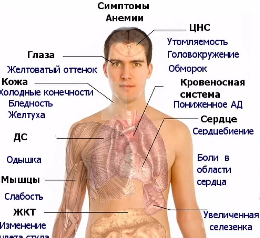 Анемия при недостатке витамина. Железодефицитная анемия симптомы. Железонедостаточная анемия симптомы. Симптомы железодеф анемии.