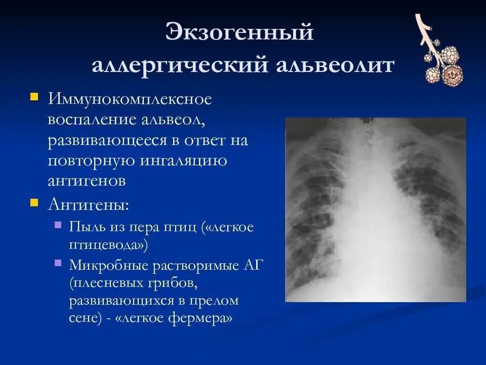 Альвеолиты рекомендации. Патогенез экзогенного аллергического альвеолита. Экзогенный альвеолит рентген. Экзогенный аллергический альвеолит рентген. Экзогенный токсико-аллергический альвеолит.