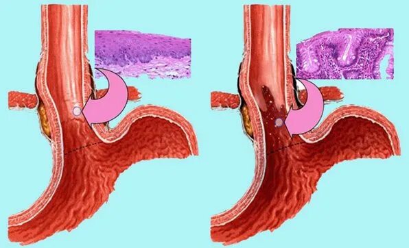 Как восстановить пищевод. Пищевод Барретта гистология. Пищевод Барретта эндоскопическая картина.
