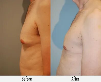 Breast Male Manhattan Reduction Surgery.