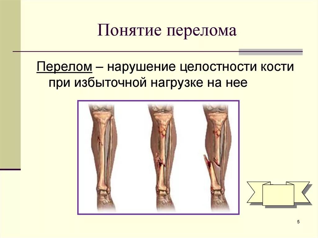 Перелом кости может быть каким. Классификация переломов костей конечностей. Переломы по степени нарушения целостности кости. Перелом открытый понятие.