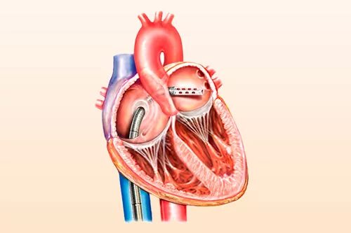Рча предсердий. РЧА желудочковой аритмии. Радиочастотная катетерная абляция. Катетерная абляция сердца что это такое.