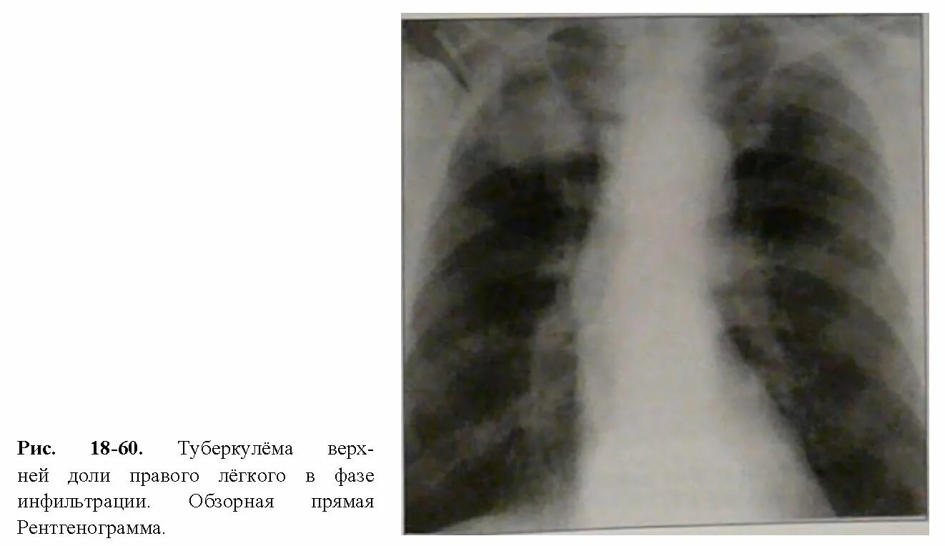 Тень в верхней доле. Туберкулома на рентгенограмме. Рентген туберкулез туберкулема. Туберкулема легкого рентген. Туберкулема в верхней доле правого легкого.
