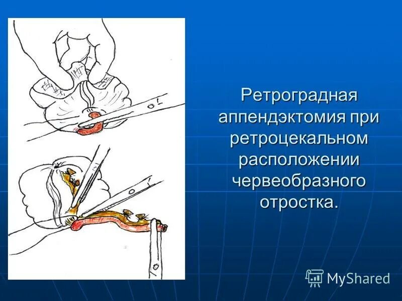 Ректальное исследование при аппендиците. Пальцевое ректальное исследование при аппендиците. Ректальное исследование при аппендиците. Острый аппендицит жалобы. Пальцевое ректальное исследование.