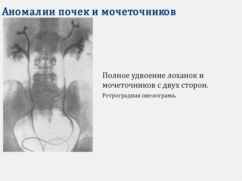 Второй мочеточник. Полное удвоение мочеточника кт. Полное удвоение почки. Удвоение лоханки и мочеточника. Полное удвоение почек и мочеточников.