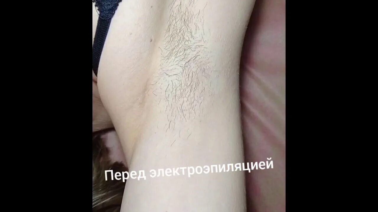 Как избавиться от волос на подмышках навсегда. Электроэпиляция подмышек до после. подмышки до и после лазерной эпиляции. как убрать волосы с подмышек навсегда.