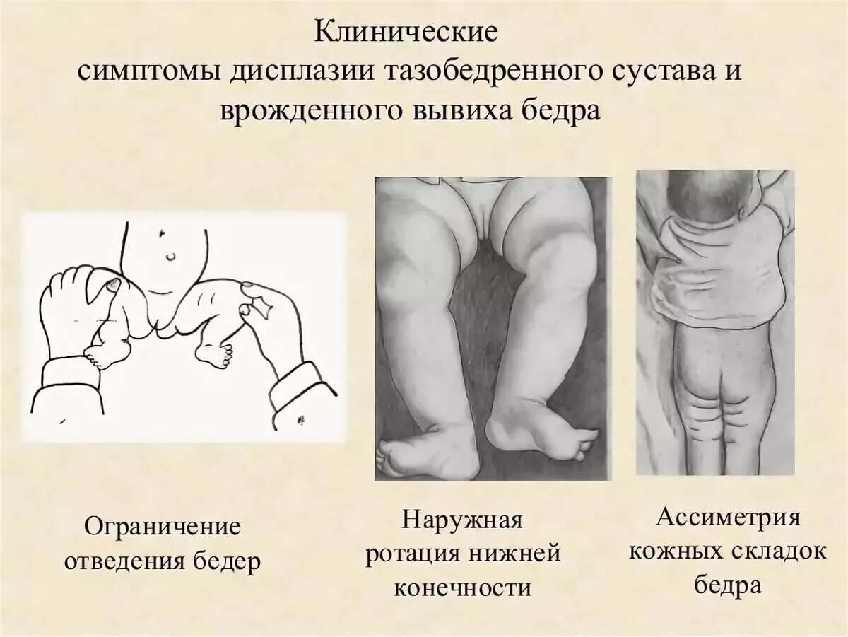 Укорочение трубчатых. Дисплазия тазобедренных суставов у ребенка 1 год. Складки при дисплазии тазобедренных суставов у новорожденных. ДТБС У ребенка 1 год симптомы. Дисплазия тазобедренных суставов у новорожденных 1б.