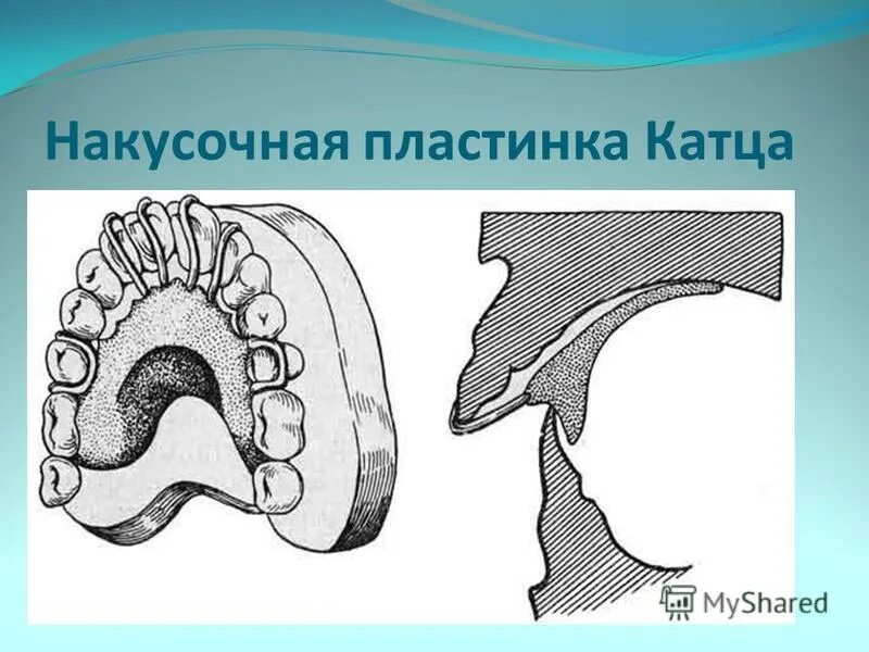 аппарат шварца пластинка. наклонная плоскость ортодонтия. 5. аппарат с накусочной площадкой ортодонтия. аппарат катца в ортодонтии.