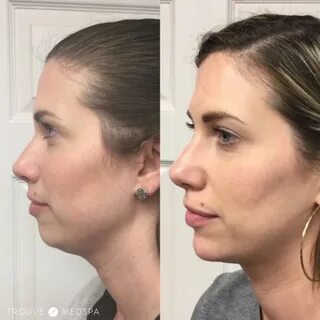 Cleft chin filler