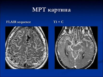 Мрт картина