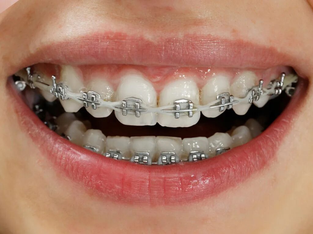 Брекеты отзывы. Damon Braces.