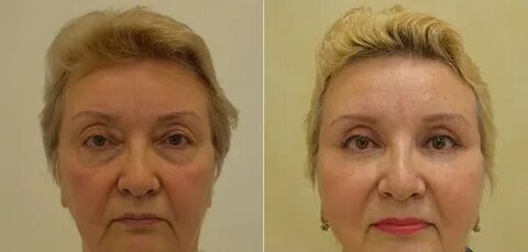 Блефаропластика верхнего века новосибирск