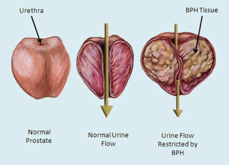 Видеоурок простата. Доброкачественная гиперплазия предстательной железы. Как выглядит аденома простаты.