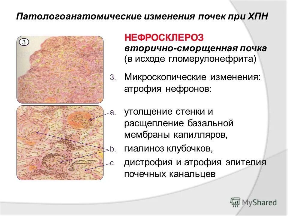 нефросклероз исход первично сморщенная почка. втоичносморщенеая почка. нефросклероз первично сморщенная почка. первично сморщенная почка патанатомия. первично сморщенная почка.
