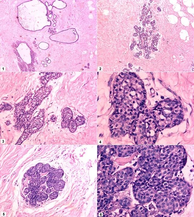 Гистология молочной железы. Дольковая карцинома in situ. Гиперхромные атипичные клетки. Клетки с гиперхромными ядрами