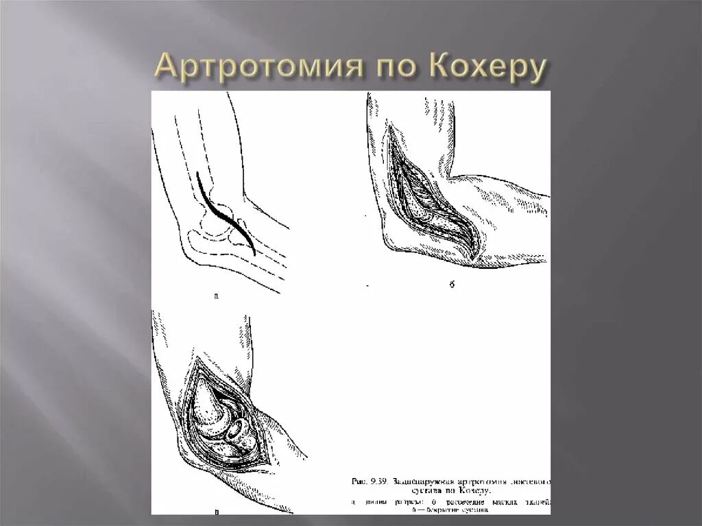 Артротомия плечевого сустава. Артротомия локтевого сустава по Кохеру. Вскрытие полости локтевого сустава. Резекция локтевого сустава по Кохеру. Артротомия локтевого сустава по Лангенбеку.