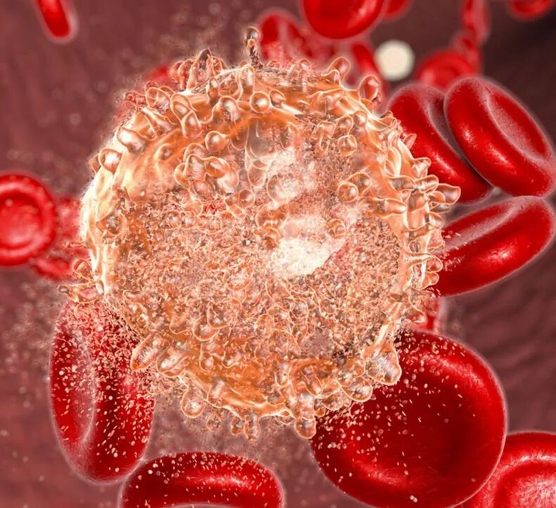 Leukemia