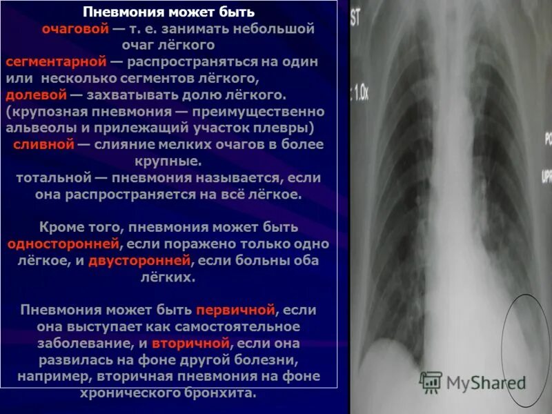 1 поражения легких. Крупозная пневмония и бронхопневмония. Очаговая пневмония. Очаг в легких при пневмонии. Одиночные очаги в легких.