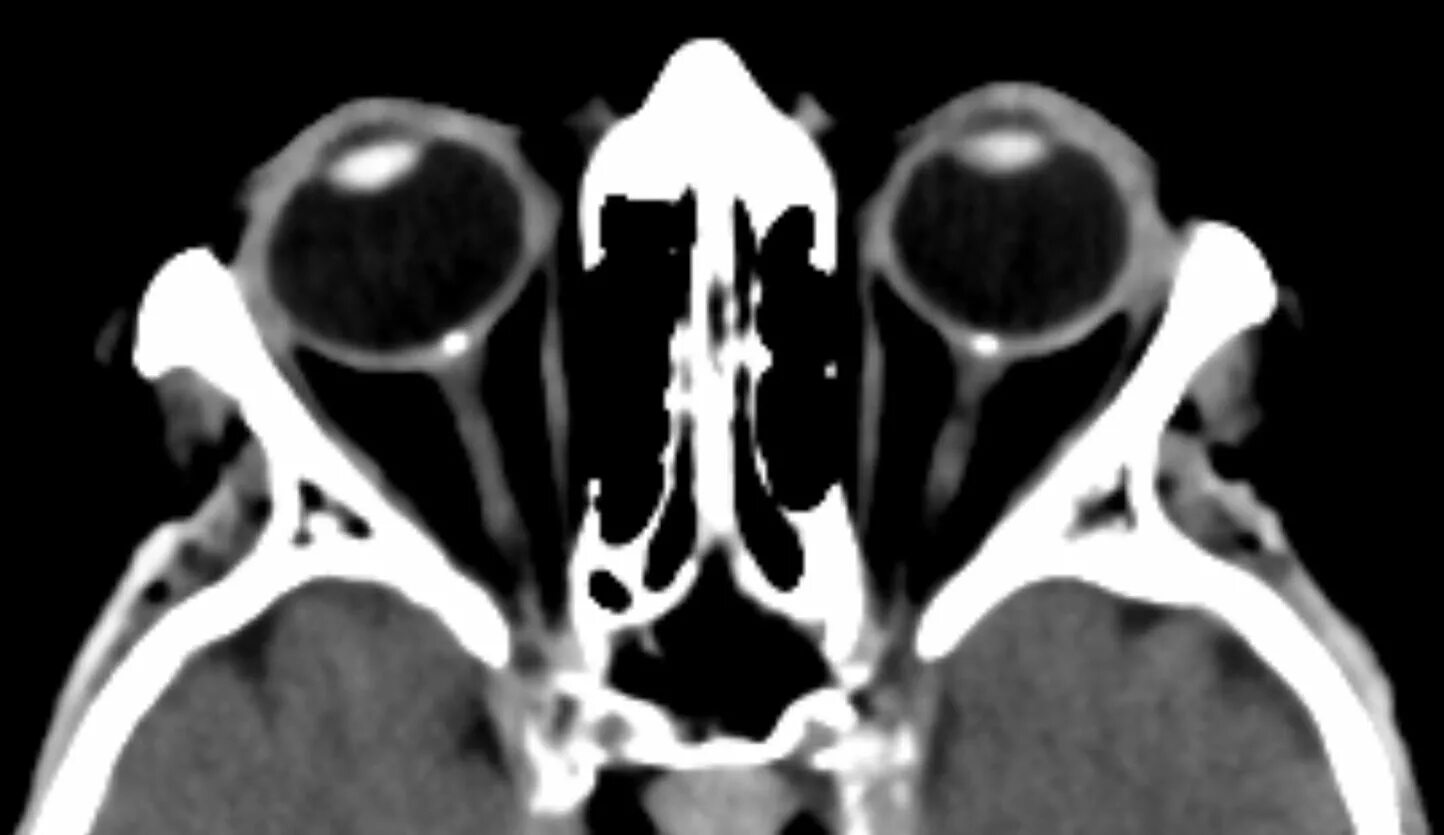 Друзы зрительного нерва на кт. Менингиома зрительного нерва кт. Атрофия зрительного нерва кт. Обызвествление зрительного нерва кт. Периневральное пространство зрительного нерва