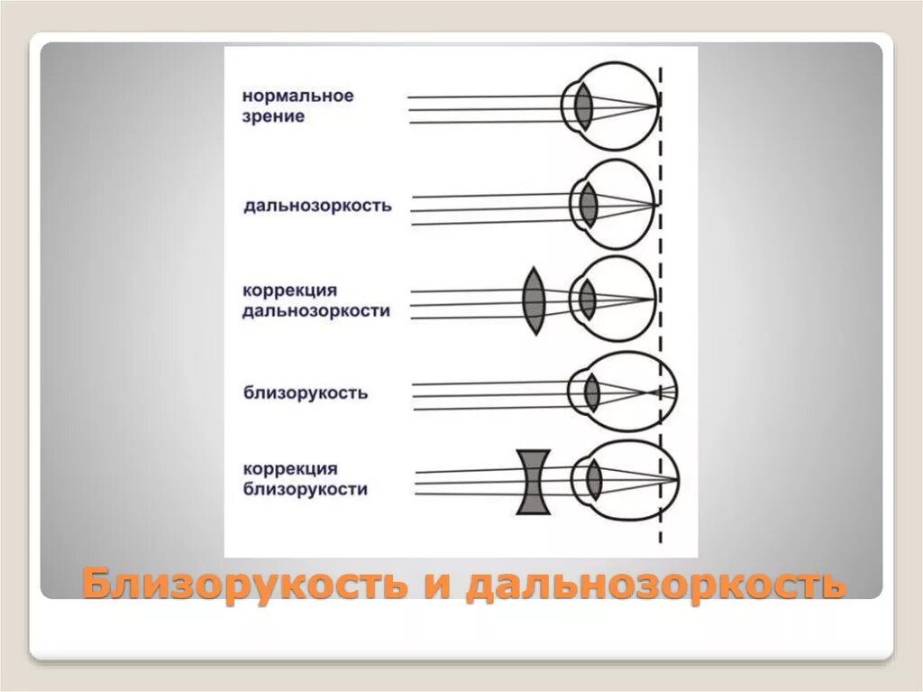 Какие точки зрения на причины и способы. Коррекция зрения близорукость и дальнозоркость. Близорукость это миопия а дальнозоркость это. Схема близорукости и дальнозоркости. Нормальное зрение дальнозоркость близорукость.