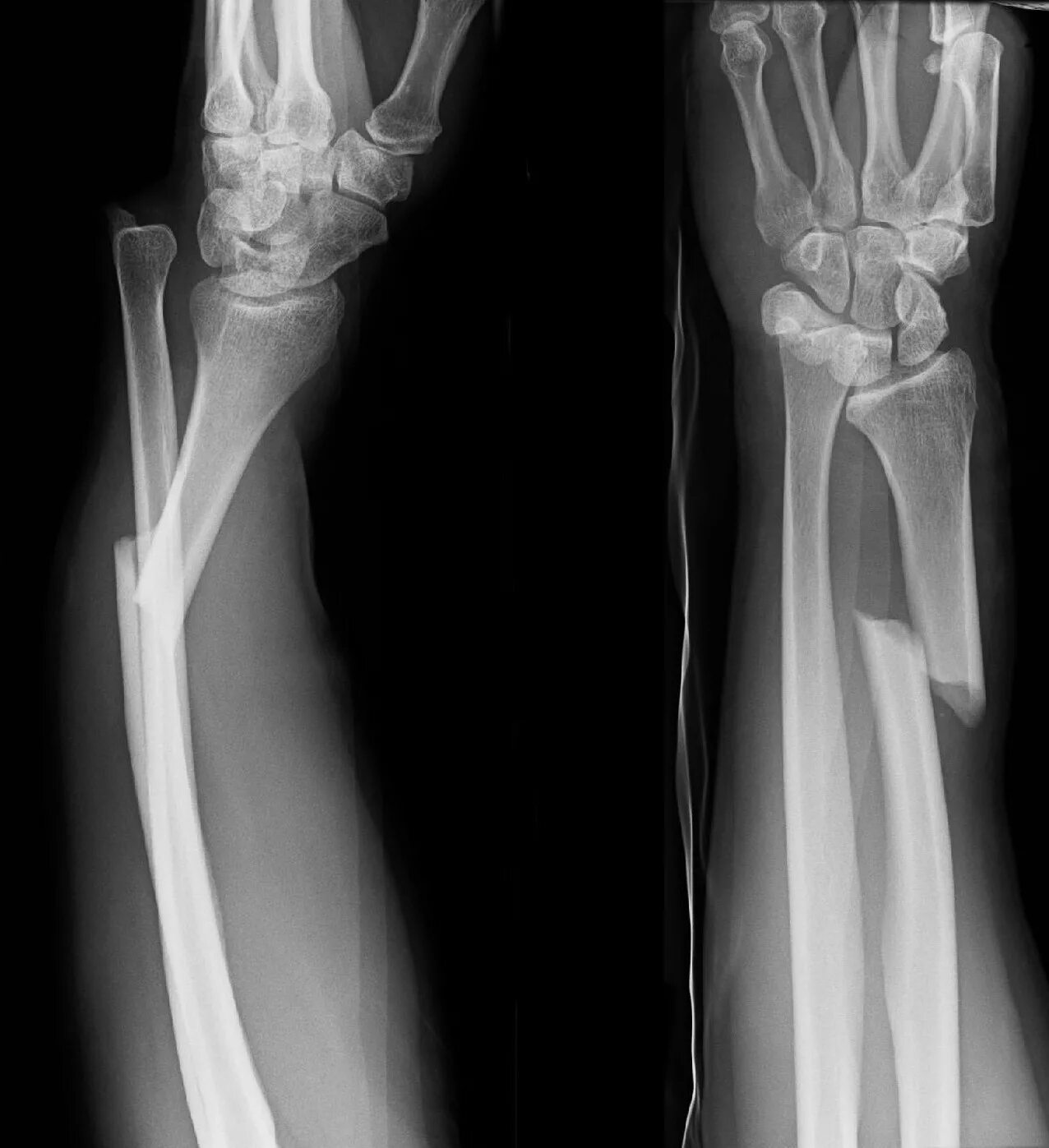 Fracture modeling