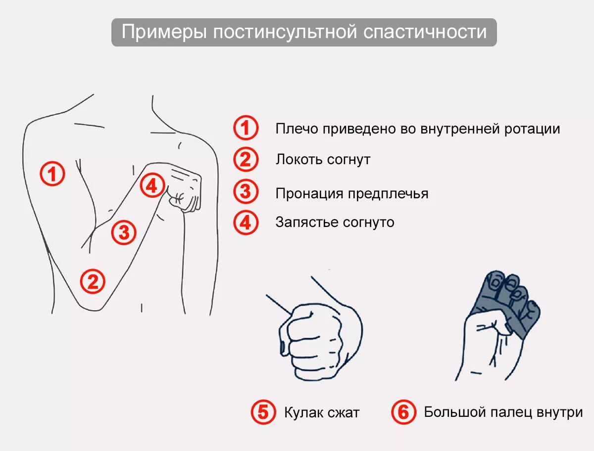 Спастичность у взрослых что это. Спастика после инсульта. Спастичность конечностей. Спастика мышц после инсульта. Спастичность верхних конечностей.