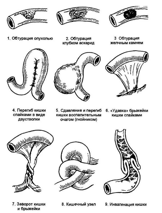 Симптомы операция кишечнике