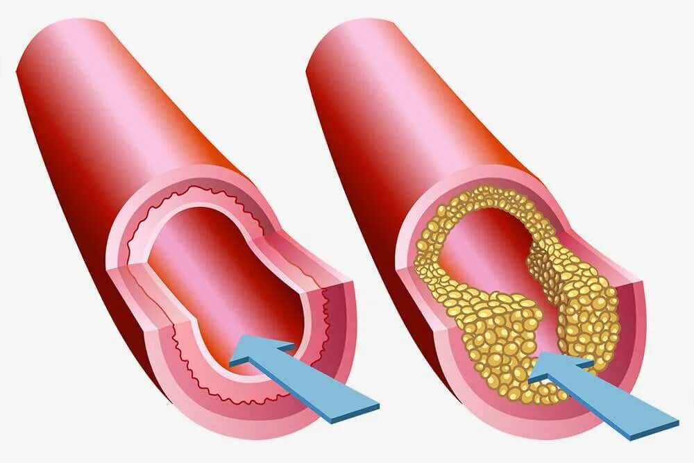 Отложение холестерина. Холестериновые бляшки в сосудах. Здоровые кровеносные сосуды. Закупоривание артерий.
