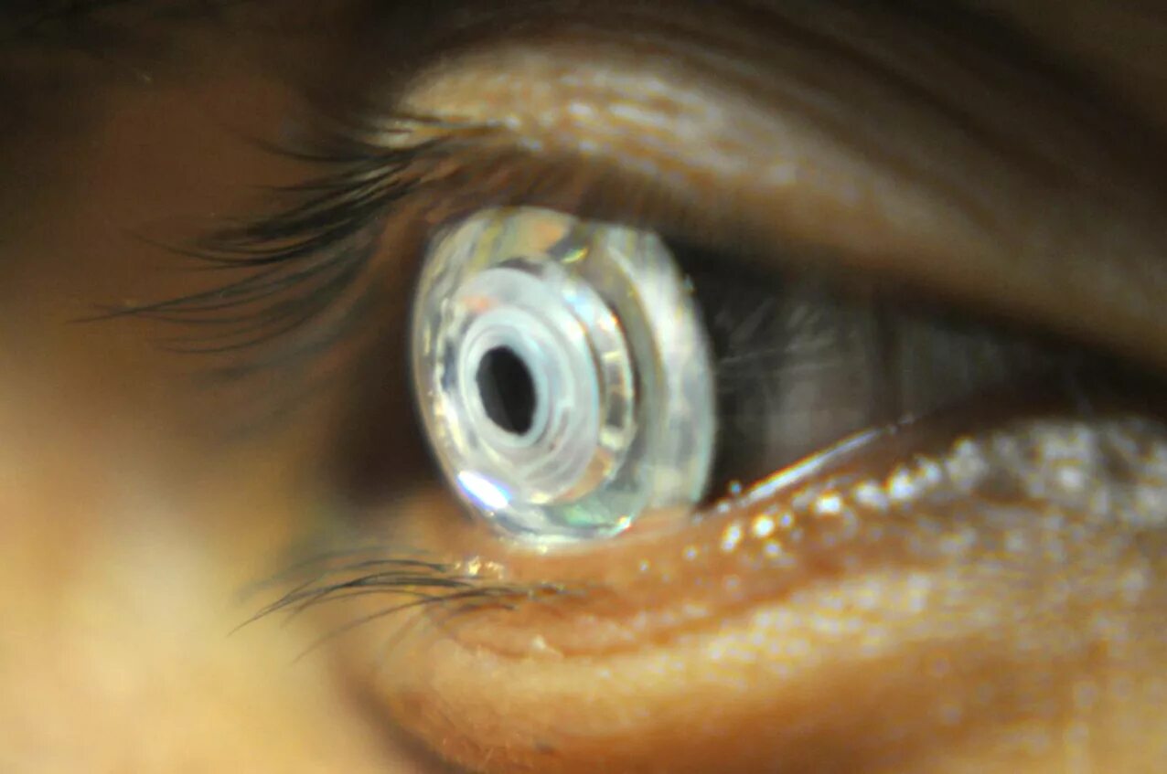 Линзы с экраном. Телескопическая контактная линза. Телескопическое зрение. Линзы со свастикой.