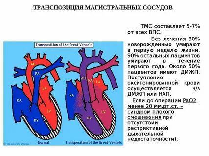 Транспозиция магистральных пороков