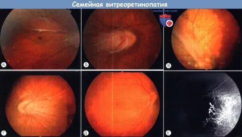 Отслойка сетчатки клинические рекомендации