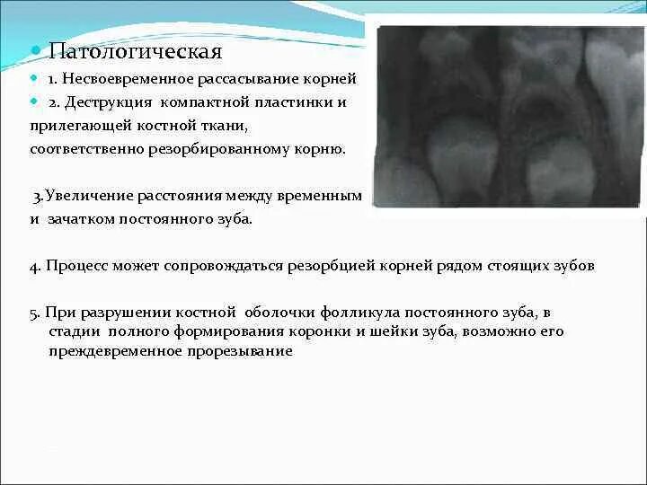 Стадии формирования корня временного зуба.