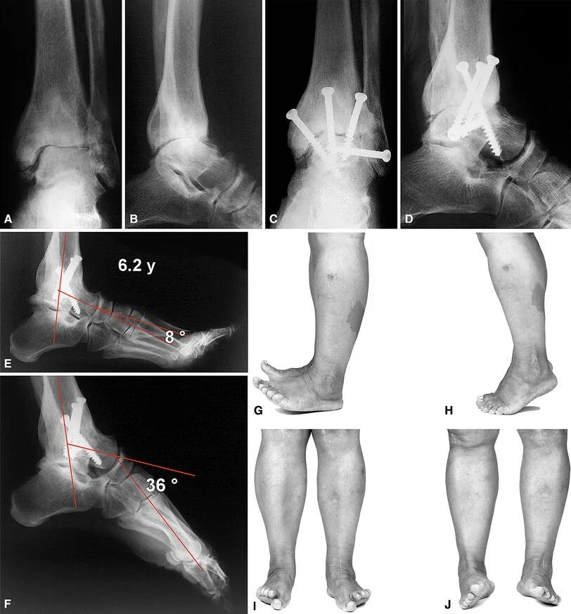 После артродеза голеностопного сустава. Артродез голеностопного сустава рентген. Ревматоидный артрит голеностопного. Операция артродез голеностопного сустава. Внутрисуставной артродез.