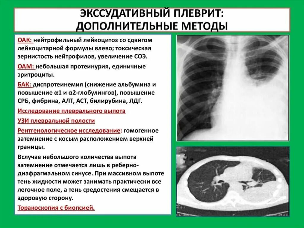 Дополнительного метода можно. Рентгенологические признаки экссудативного плеврита. Экссудативный плеврит рентген симптом. Сухой и выпотной плеврит. Экссудативный плеврит на кт.