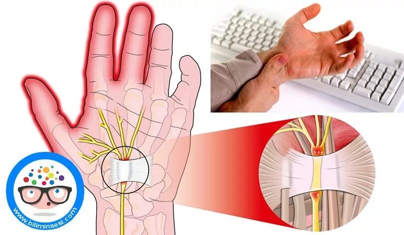Туннельный синдром кисти руки. Карпальный туннельный синдром. Туннельный карпальный синдром руки. Синдром запястного (карпального) канала. Туннельный синдром после операции