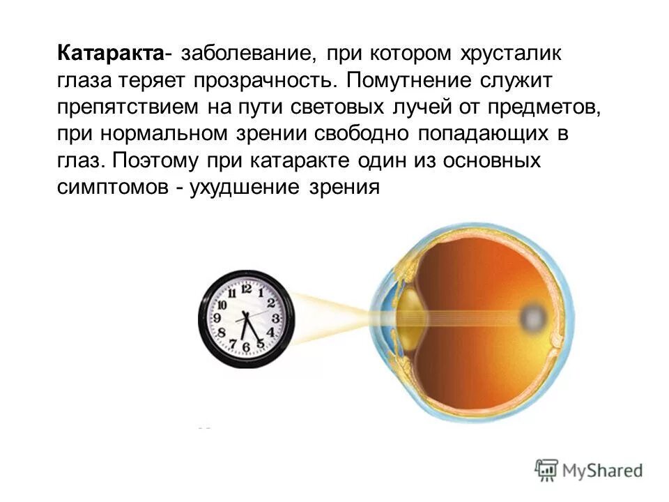 Когда восстанавливается зрение после замены хрусталика. Нормальное зрение у человека. Путь световых лучей через глаз.