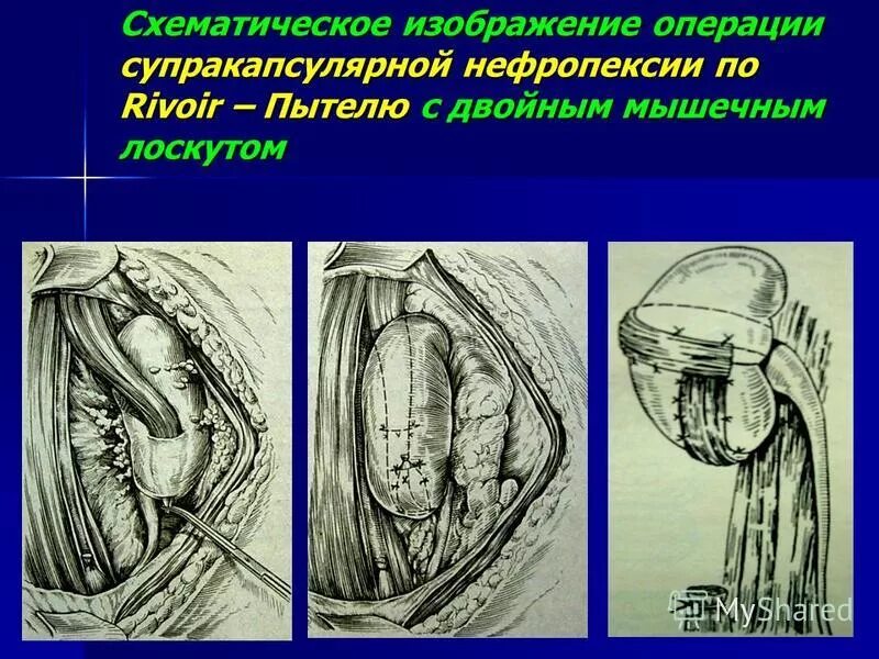 Нефроптоз нефропексия. Операция нефропексии. Нефропексия оперативная хирургия. Операция пытеля лопаткина. Нефропексия пытеля лопаткина.