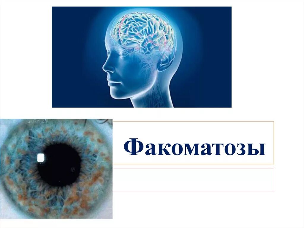 Туберкулезный склероз