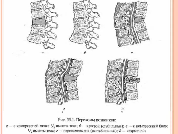 Повреждения позвоночника переломы. Классификация нестабильных переломов позвонков. Компрессионный перелом позвоночника классификация. Классификация компрессионных переломов позвонков. Стабильный компрессионный перелом тела позвонка.