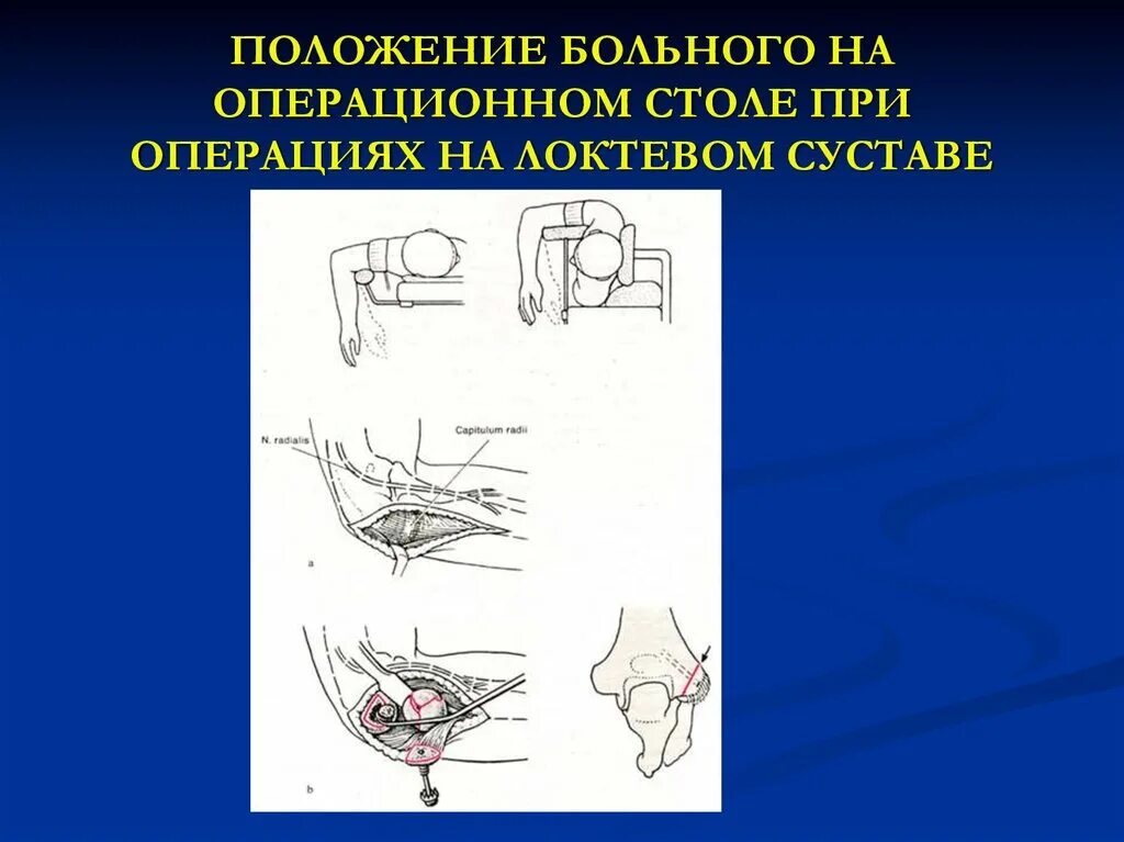 Операция локтя руки. Операция на локтевом суставе. операции на локтевом отростке. положение пациента при операции на локтевом суставе. принципы операций на локтевом суставе.
