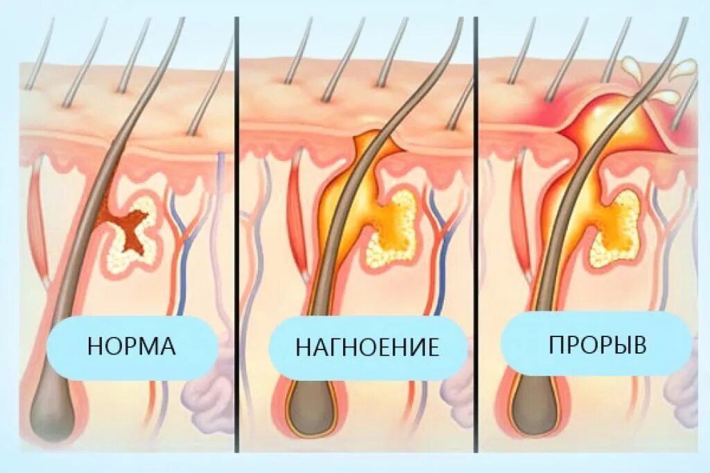 Этапы развития фурункула. Фурункулез волосяных фолликулов. Гнойную степень