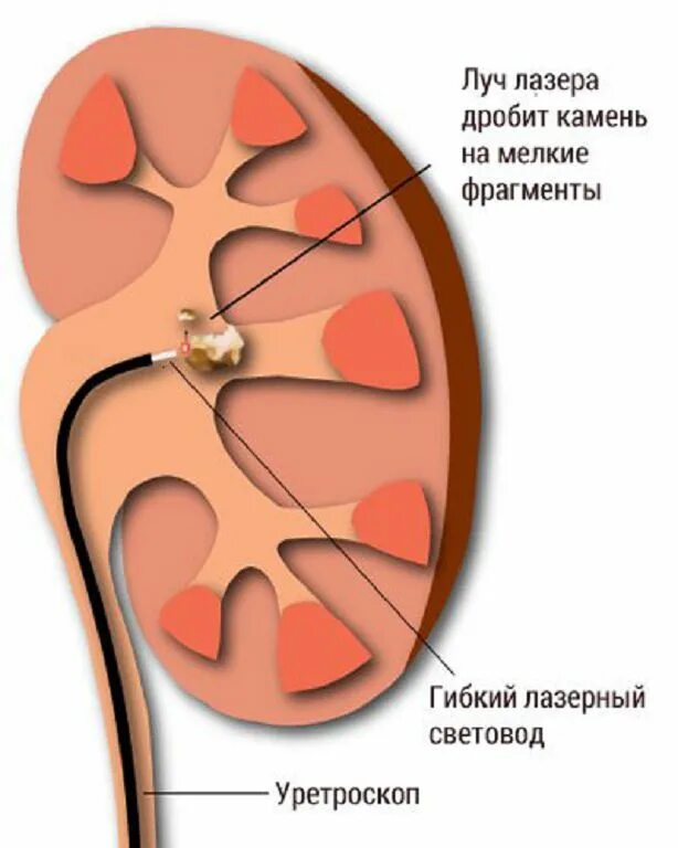 Как дробят камни в мочеточнике. Лазерная литотрипсия камней. Дробление камней в почках лазером. Контактная литотрипсия камней в почках. Дробление камней в почках лазером и ультразвуком.
