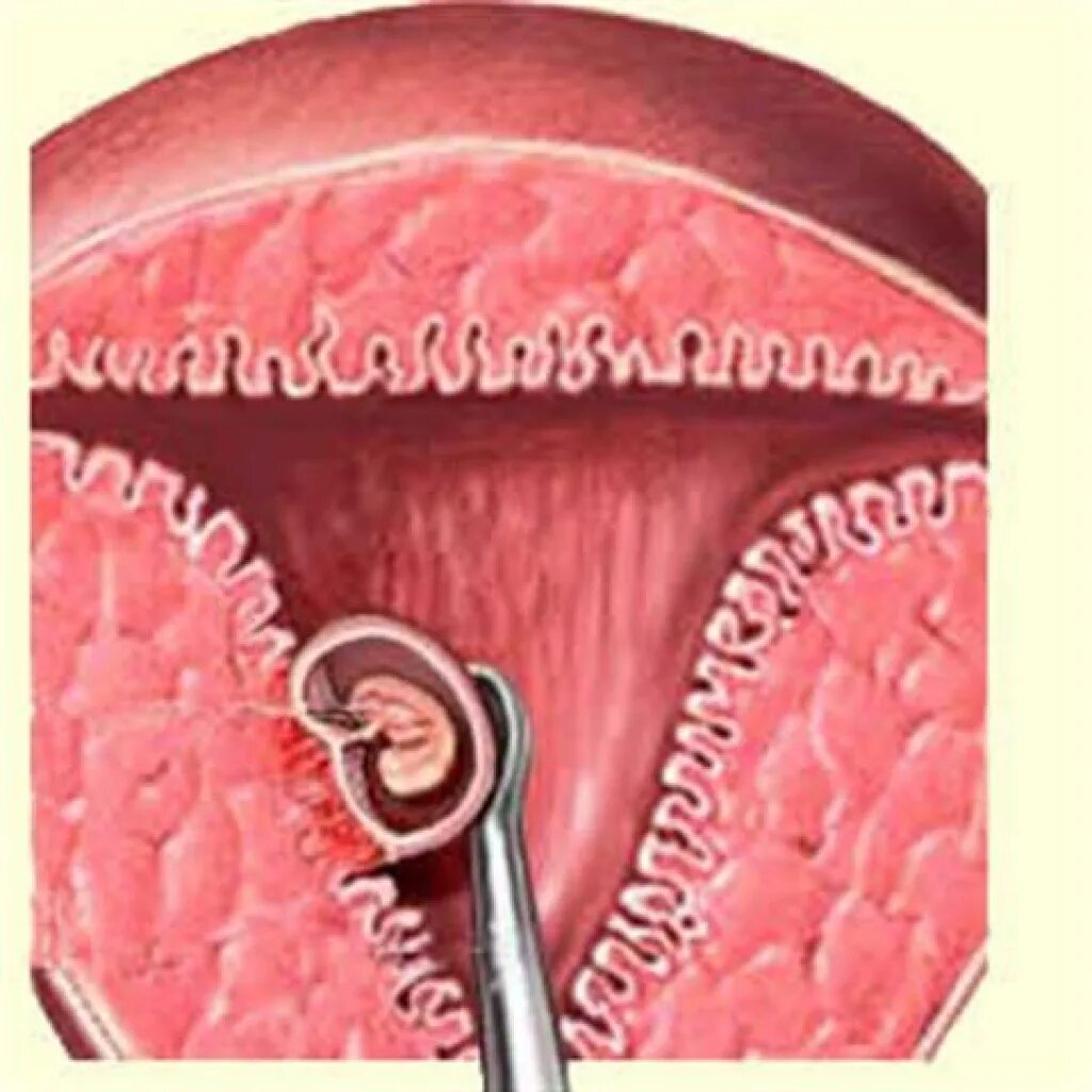 Как называется выскабливание. Выскабливание слизистой оболочки матки. Выскабливание плацентарной полипа. Выскабливание эндометрия. Выскабливание полости матки беременности.
